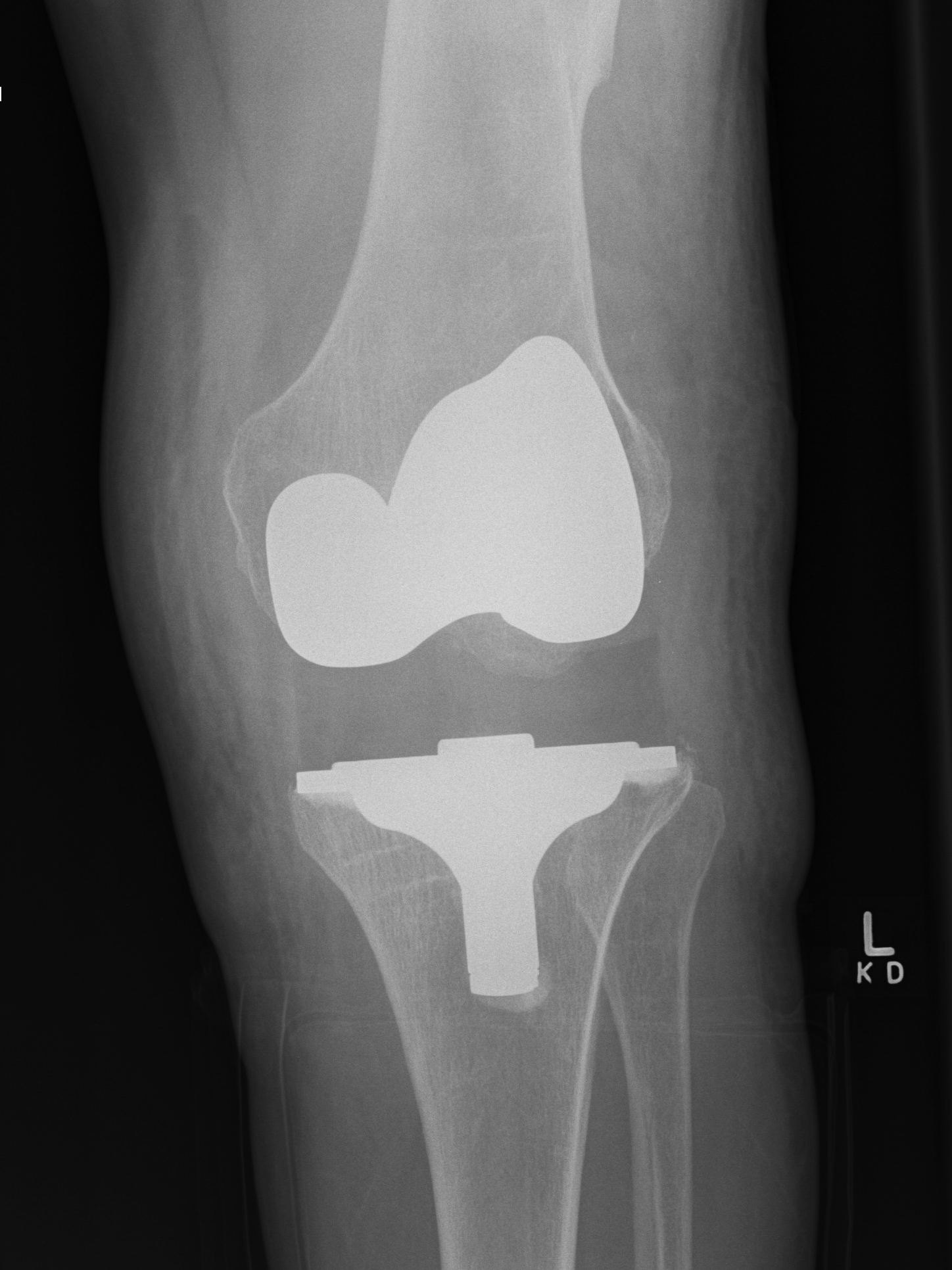 TKR Varus Instability Increase Poly Thickness